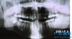 阻生牙拔除术:阻生牙不拔的后果
