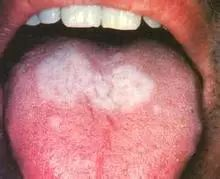 口腔舌扁平苔藓是病吗？什么症状？