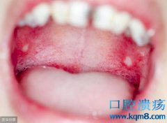口腔里某些癌症可能表现为口腔溃疡，经常得口腔溃疡的人需要担心吗？