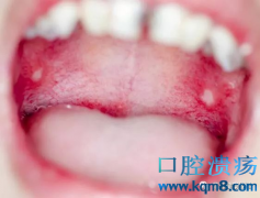 口腔溃疡频繁出现这5种症状，当心引发口腔癌