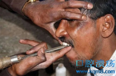 印度街头游医 拔牙用钳子不打止痛针 摆摊就能开工