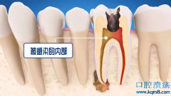牙疼根管治疗好还是直接补牙好？
