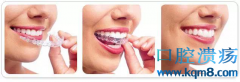 口腔正畸用的隐形牙套怎么做出来的？