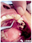 口腔蝇蛆病感染的症状