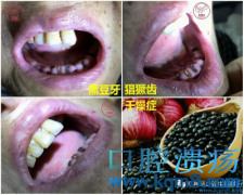 黑豆牙 猖獗齿 镜面舌 干燥症