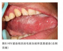 艾滋病引起的舌头毛状白斑怎么办？