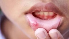 口腔溃疡白色与黄色区别都哪些?发病原因及治疗方法