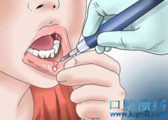 口腔溃疡诊断方法与治疗秘方！