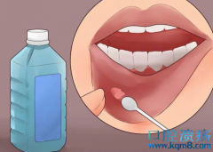 口腔溃疡发病原因及治疗原则