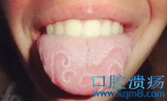 舌炎患者日常如何护理？