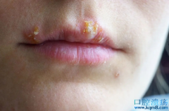 嘴角上火起水泡，口唇疱疹竟是单纯疱疹病毒（HSV）感染！