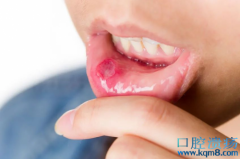嘴里长口腔溃疡，是缺乏维生素？