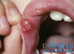 口腔溃疡对我们有什么影响？