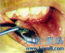 口腔溃疡的临床症状表现