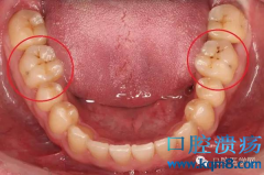 牙齿上面的小黑点是什么？你可能龋齿了