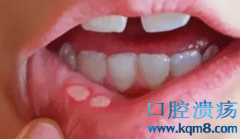 女子口腔溃疡没在意，结果被确诊为舌癌！
