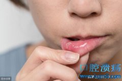 口腔溃疡怎么治疗？
