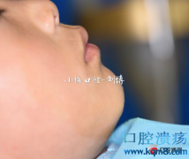 8岁男孩上颌切牙－尖牙区组合性牙瘤摘除一例