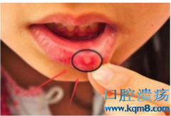 口腔溃疡就是口腔癌的前兆？