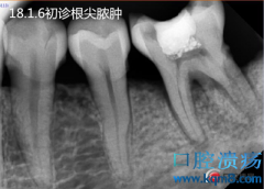 拔牙后出现下颌骨骨髓炎怎么办？