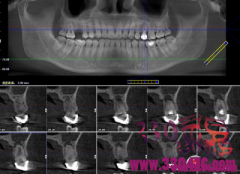 后牙冠延长修复，后牙根管治疗后做嵌体修复