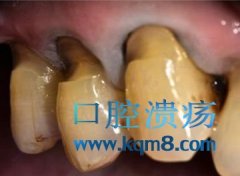 楔状缺损的牙修复时需要备洞形吗？