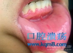 口腔溃疡的原因压力过大,免疫系统异常都会引起这个疾病