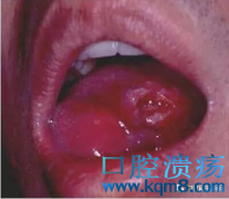 活血良口汤：口黏膜扁平苔藓该怎样鉴别诊断？