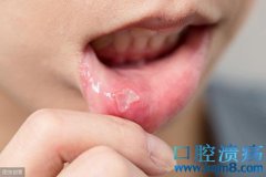 口腔溃疡怎么预防？