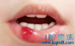 口腔溃疡——白塞病的前期症状表现