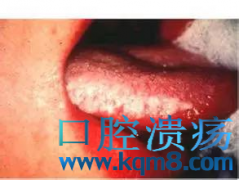 口腔毛状白斑:一种与艾滋病同在的口腔疾病