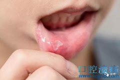 儿童口腔溃疡发病原因及儿童口腔溃疡认识误区