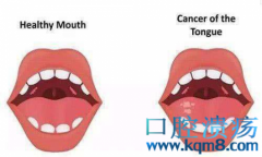 舌癌术后康复功能训练（上）—如何更好地恢复言语功能？