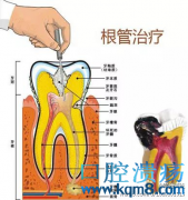 口腔问题——牙髓炎