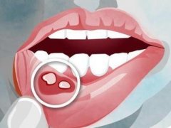口腔溃疡秘方:口疮断生饮治疗复发性口疮