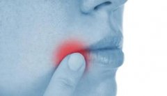 13个常见口腔溃疡验方治疗多年口疮久治不愈
