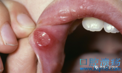 口腔医生：5个办法减少口腔溃疡疼痛，促进溃疡愈合