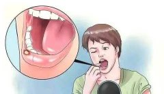 口腔溃疡的类型有哪些呢?