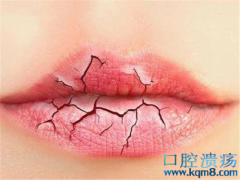 如何预防唇炎？
