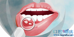 口腔溃疡反复发作如何预防治疗？
